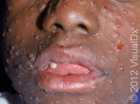 Chickenpox can cause small sores inside the mouth as well as numerous blisters and scabs on the skin.