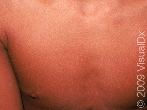 This viral rash shows overall redness of the trunk as well as prominence of the hair follicles (above the nipple area).