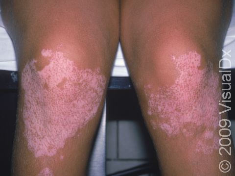 This image displays lightening of the skin due to vitiligo, with pigment beginning to return around each hair follicle.