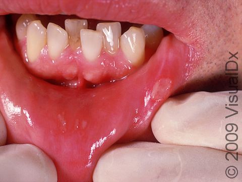 This image displays white-to-yellow lesions typical of apthous ulcers.