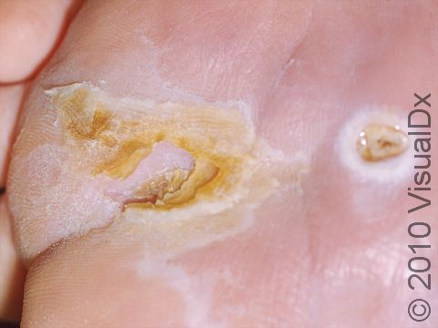 A neurogenic ulcer begins with thickening and a callus on an area of pressure, as seen on the left on this foot, followed by skin breakdown (an ulcer), as seen on the right.