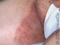 Jock Itch (Tinea Cruris) – Adult