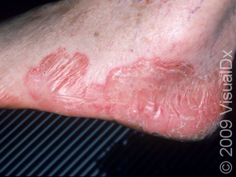 This image displays the red and inflamed skin with a scaly edge typical of tinea pedis (athlete's foot).