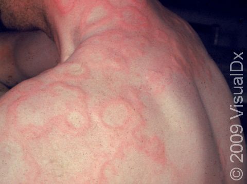 This image displays urticaria (hives).