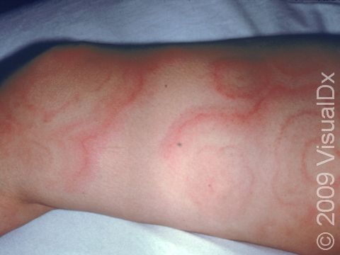 This image displays a severe case of urticaria (hives).