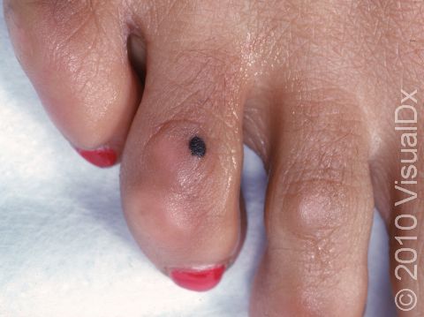 A mole is seen on the fourth toe, next to a callus caused by wearing ill-fitting shoes. Note that the color and border of the mole are regular.