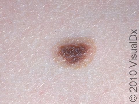 This benign (non-cancerous) nevus (mole) has a regular border and a symmetrical shape.