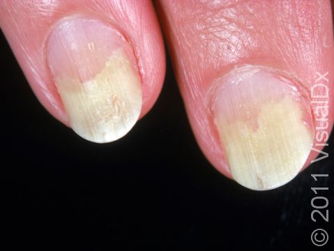 This image displays onycholysis, which means lifting of the nail from the nail bed.