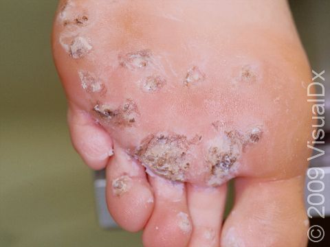 This image displays multiple plantar warts.