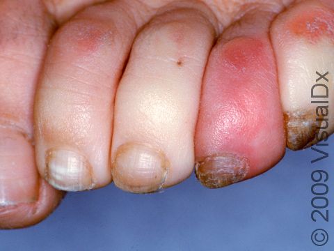 This image displays white toes from constriction of the skin's blood vessels.