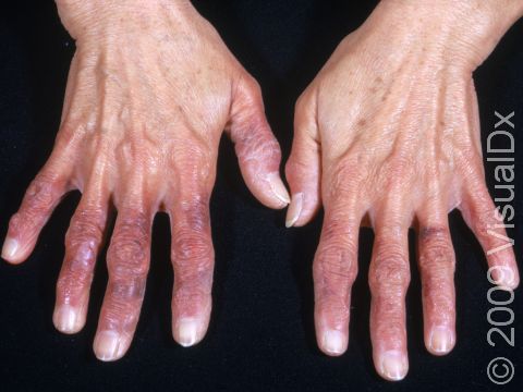 This image displays fingers that are purple and chronically cold due to Raynaud's disease.