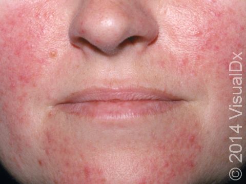 Rosacea can cause redness and dilated blood vessels, as displayed in this image.