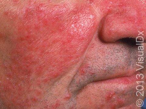 This image displays severe rosacea.