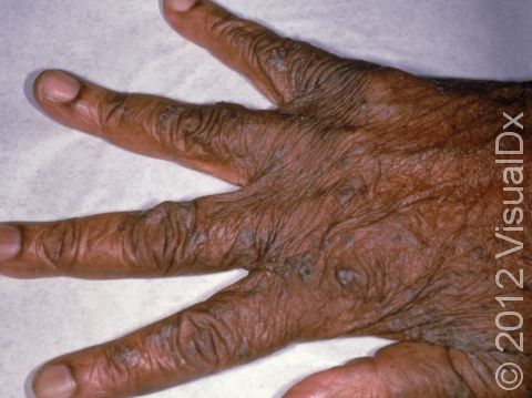 The red bumps typical of scabies are harder to see on the back of the fingers and hands in people with darker skin, as displayed in this image.