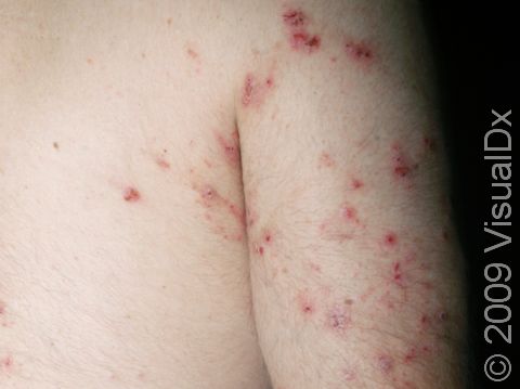 This image displays lesions that have been severely scratched due to a prolonged scabies infection.