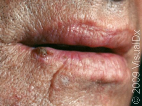 This image displays a crusting and bleeding lesion on the lower lip typical of squamous cell carcinoma.