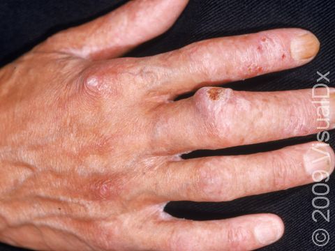 This image displays multiple areas of sun damage and a large squamous cell carcinoma on the middle finger.