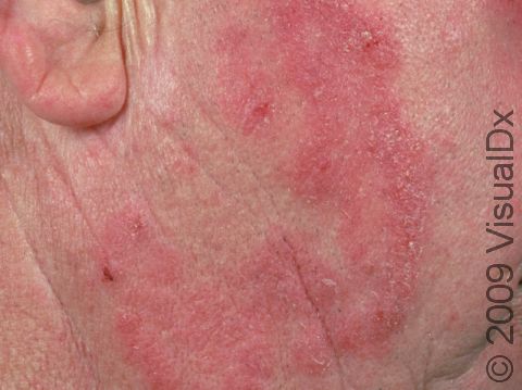 As displayed in this image, large patches of tinea (ringworm) will often have a central area of clear skin.