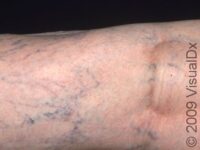 Varicose Veins (Varicosities) – Adult