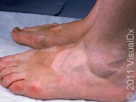 This image displays vitiligo on the backs of feet.