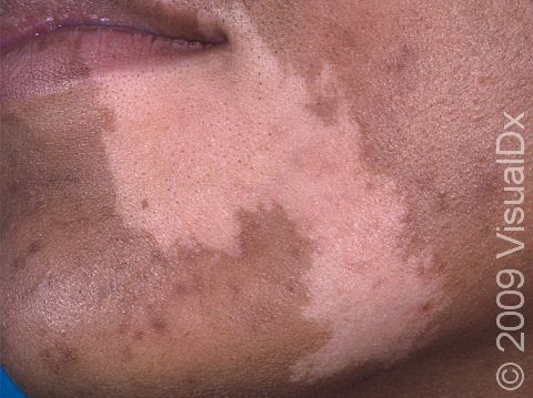 In people with darker skin, the areas of pigment loss in vitiligo are quite distinct.