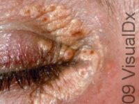 Xanthelasma Palpebrarum – Adult