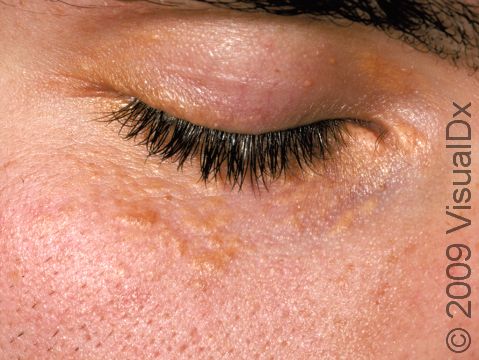 This image displays yellow-white elevations of the skin in a patient with early xanthelasma palpebrum.