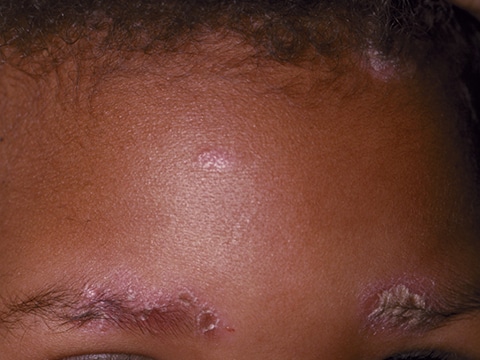 Multiple pink psoriasis plaques on the face and scalp of a child.