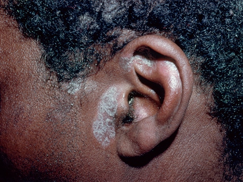 Subtle pink, scaly skin lesions of the ear and scalp of a patient with plaque psoriasis.