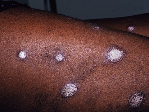 Typical raised, red skin lesions of plaque psoriasis with their characteristic thick white scale. Redness may be subtler in darker skin colors.