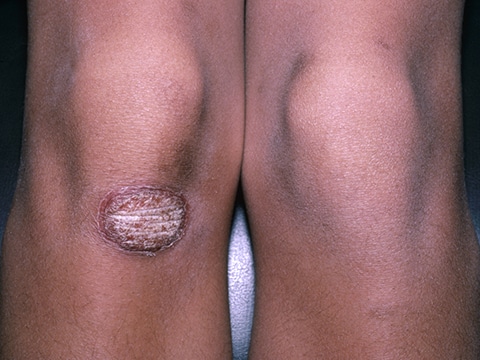 An isolated circular lesion of plaque psoriasis on the knee with compact white scale and red-purple discoloration.