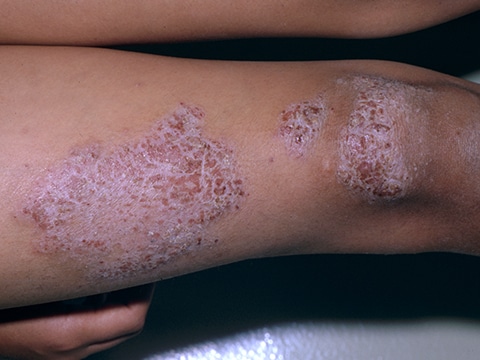 Some patients with plaque psoriasis may develop thinner, raised, pink lesions without the classical thick white scale.