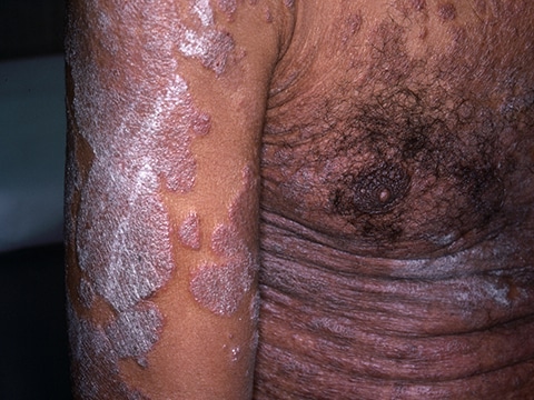 Large scaly lesions on the arm and trunk of a patient with typical plaque psoriasis. In darker skin colors, lesions of plaque psoriasis may appear pink, purple, silver, grayish, or dark brown.