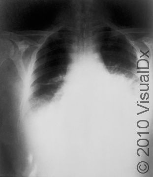 This chest X-ray of a patient with inhalational anthrax shows a widened mediastinum (area at the center of the chest near the heart). This radiograph was taken 22 hours before death.