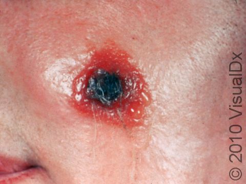 In cutaneous anthrax, a blister (vesicle or bulla) is the first skin lesion. This transient fluid-filled lesion quickly breaks, and then a black scab (eschar) develops at the center within days.