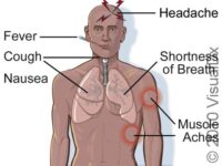 Avian Influenza H5N1 (Avian Flu, Bird Flu) – Atlas