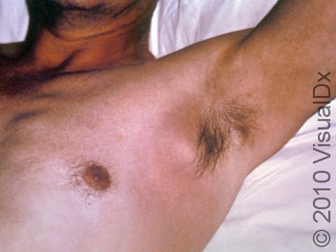 A large, swollen, red lymph node (bubo) in the armpit (axillary) of a person with bubonic plague. Symptoms of the plague are severe and include a general weak and achy feeling, headache, shaking chills, fever, and pain and swelling in affected regional lymph nodes (buboes).