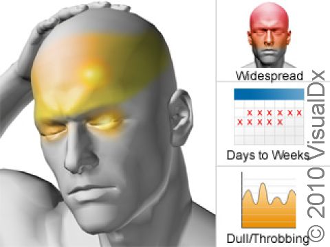 A chronic migraine typically involves the whole head with focused, throbbing pain on one side. A chronic migraine is defined by daily or nearly daily headaches for 15 or more days a month for more than 3 months.