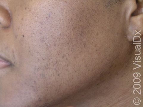 AFTER: The cheek of a patient with ethnic skin after laser hair removal (in this instance, by 6 treatments with a long-pulsed Nd:YAG laser).