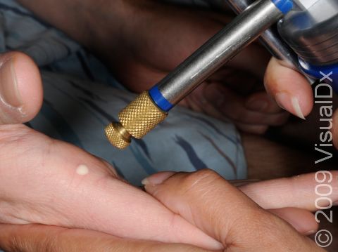 Liquid nitrogen can be applied by spray device, as seen here, or delivered by a cotton-tipped applicator.