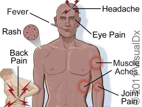 Dengue fever is a viral disease transmitted by mosquitoes. Primarily localized to the Caribbean region and Central and South America, new cases have recently been seen in South Florida and Texas. 