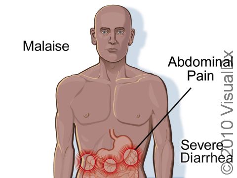 Intestinal illness caused by E. coli bacteria will typically consist of severe diarrhea, abdominal cramps, and malaise.