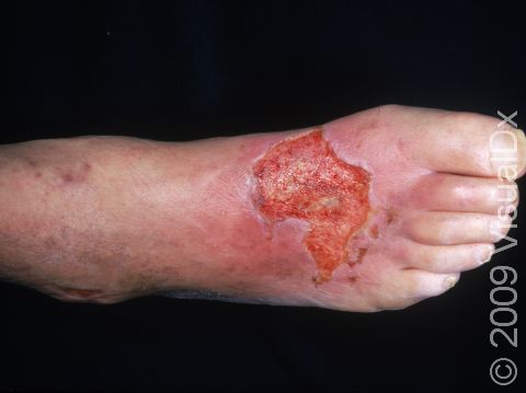 This severe burn on the top of the foot was caused by a hot grease spill.