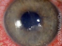 Corneal Abrasion, First Aid – First Aid