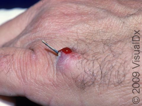 The barb of a fishhook is a fairly common foreign object in the skin.