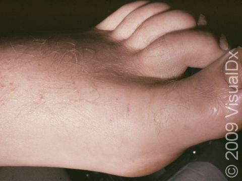 The swelling and injury itself can be subtle following a bite from a nonvenomous snake.