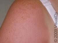 Sunburn, First Aid – First Aid