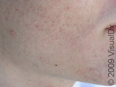 AFTER: Following acne laser treatment, the appearance of acne scars on this patient's cheek has been reduced.