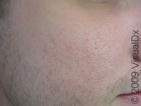 AFTER: Following fractional resurfacing for laser skin renewal, the appearance of this patient's acne scars has been reduced.