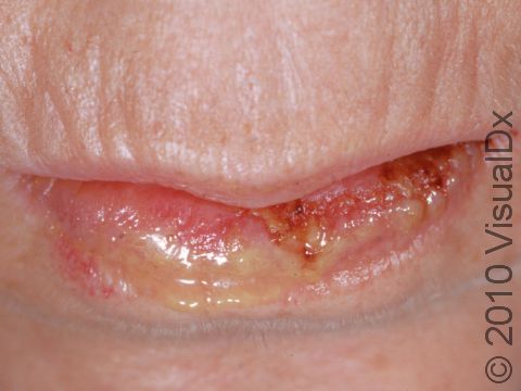 Crusting and loss of the skin of the lip frequently occurs with pemphigus vulgaris.